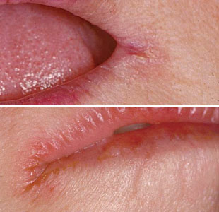 Cracked corners of the mouth